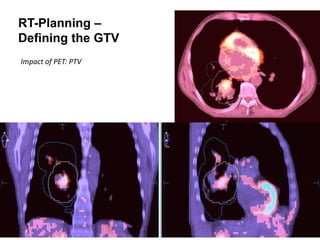 RT-Planning –
Defining the GTV
Impact of PET: PTV
 