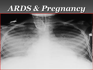 ARDS & PregnancyARDS & Pregnancy
 