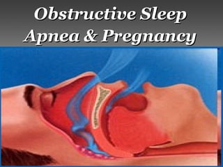Obstructive SleepObstructive Sleep
Apnea & PregnancyApnea & Pregnancy
 