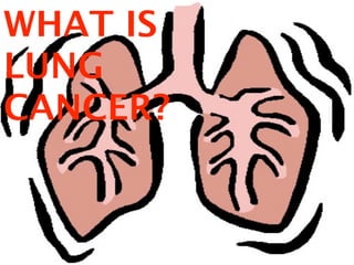 WHAT IS
LUNG
CANCER?
 