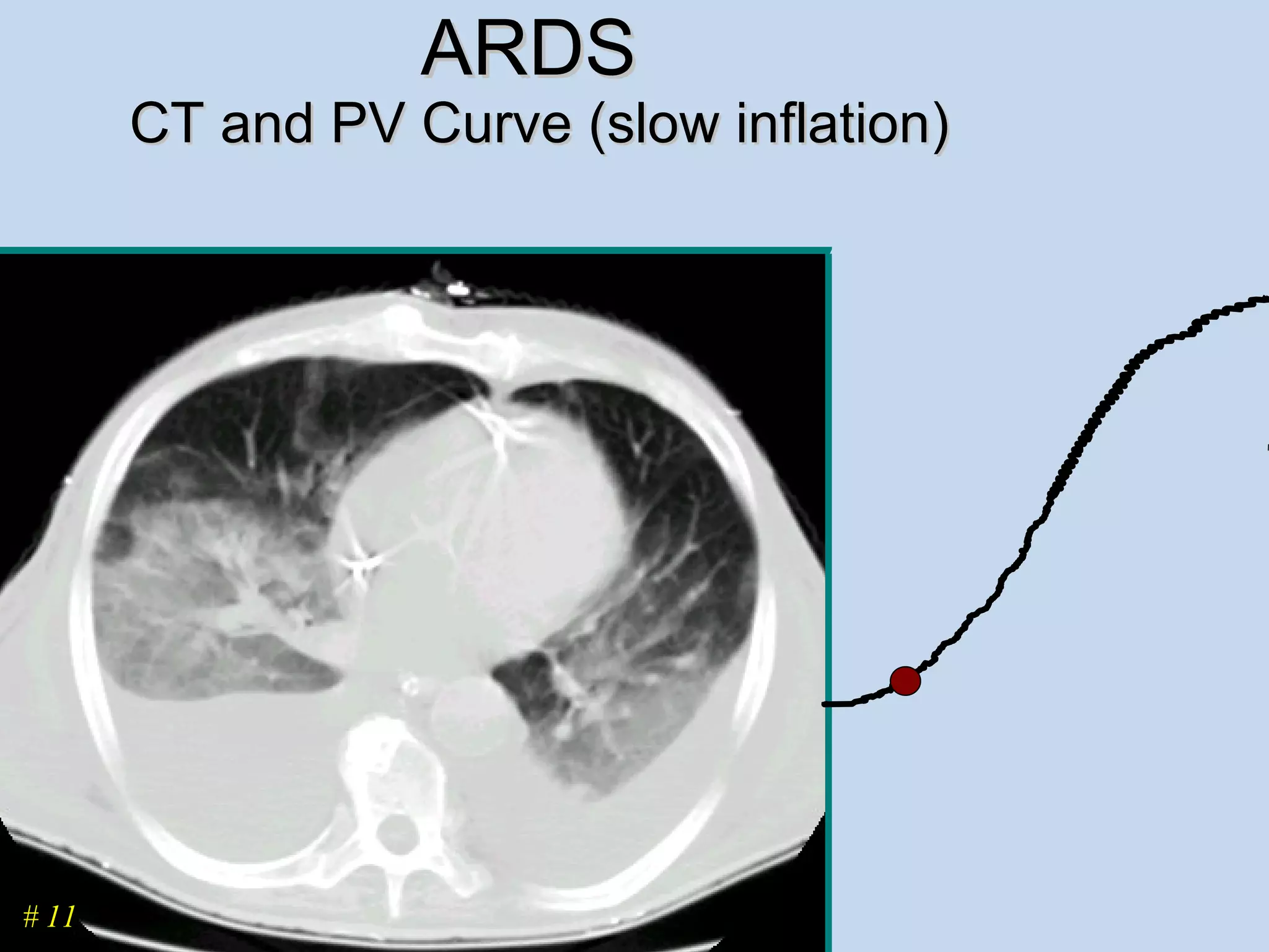 ARDS  CT and PV Curve (slow inflation) # 11 