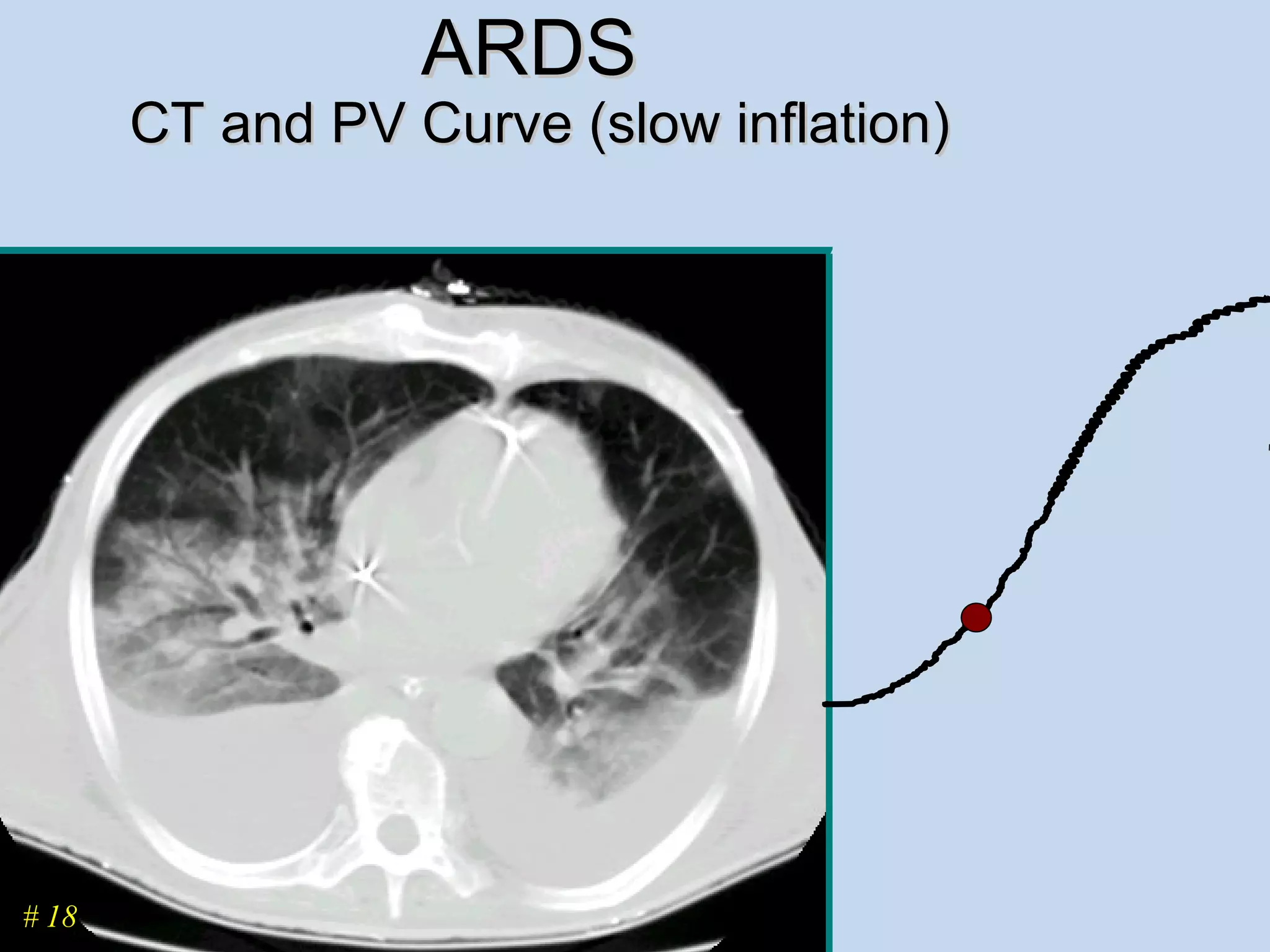 ARDS  CT and PV Curve (slow inflation) # 18 