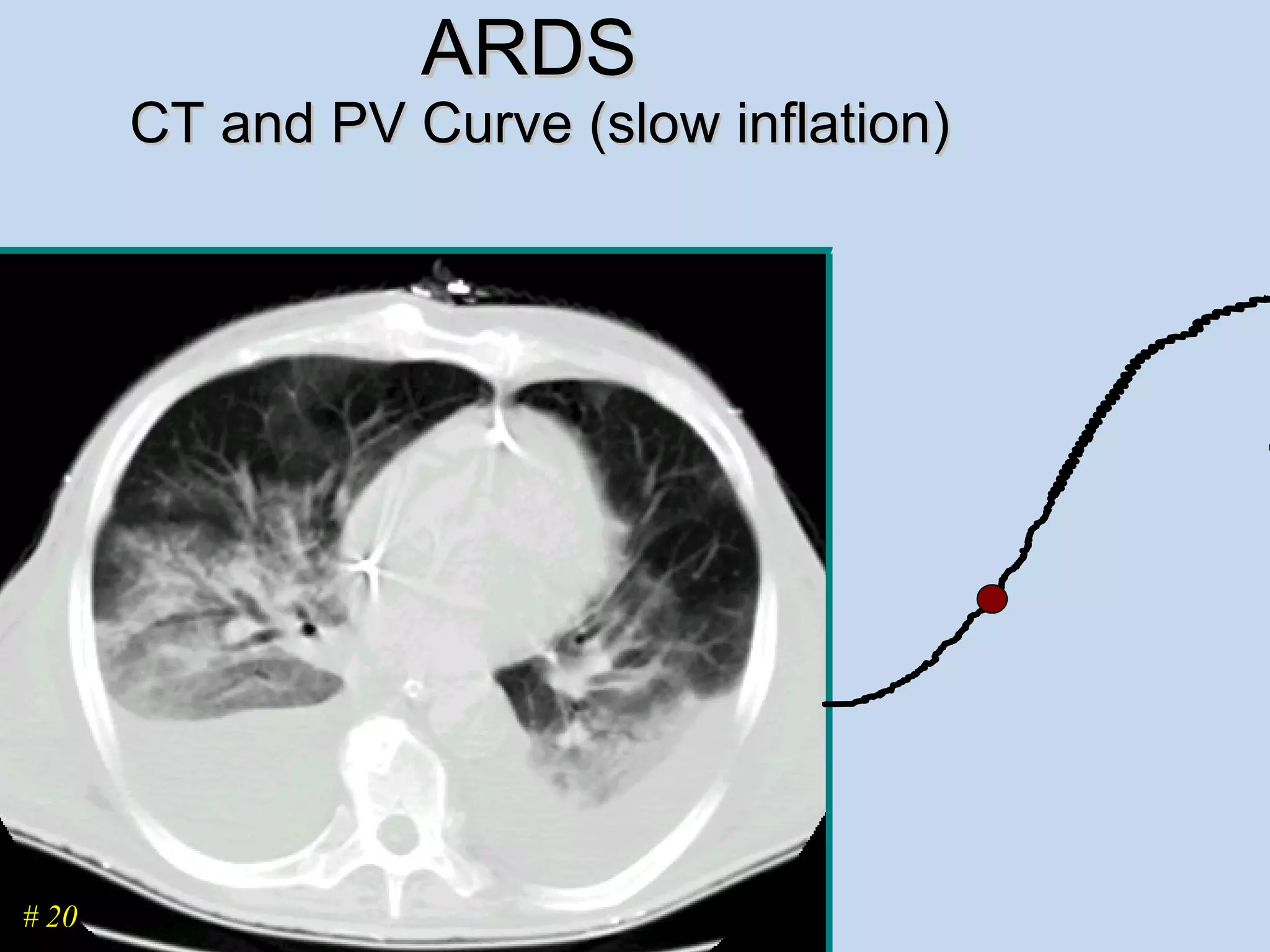 ARDS  CT and PV Curve (slow inflation) # 20 