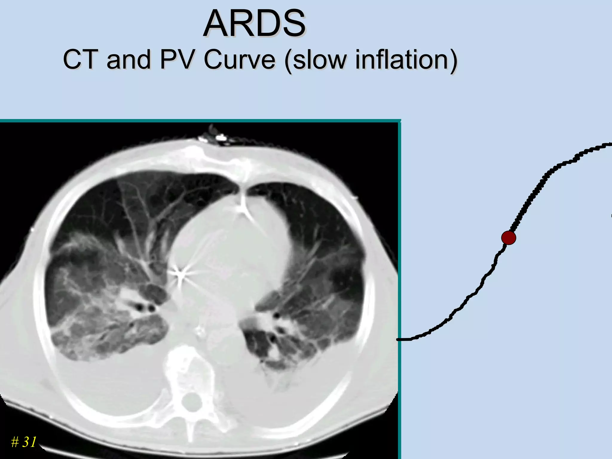 ARDS  CT and PV Curve (slow inflation) # 31 