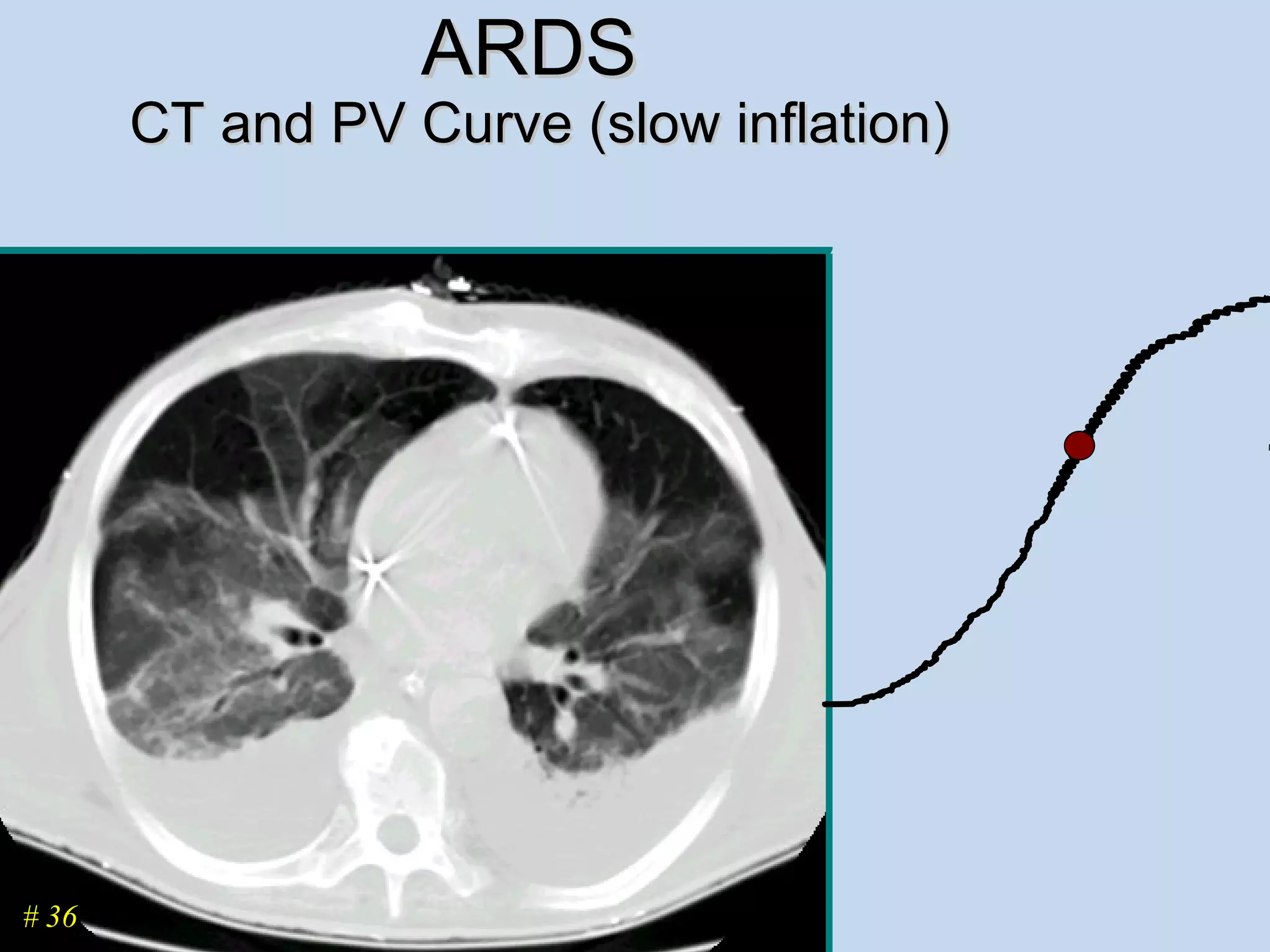 ARDS  CT and PV Curve (slow inflation) # 36 