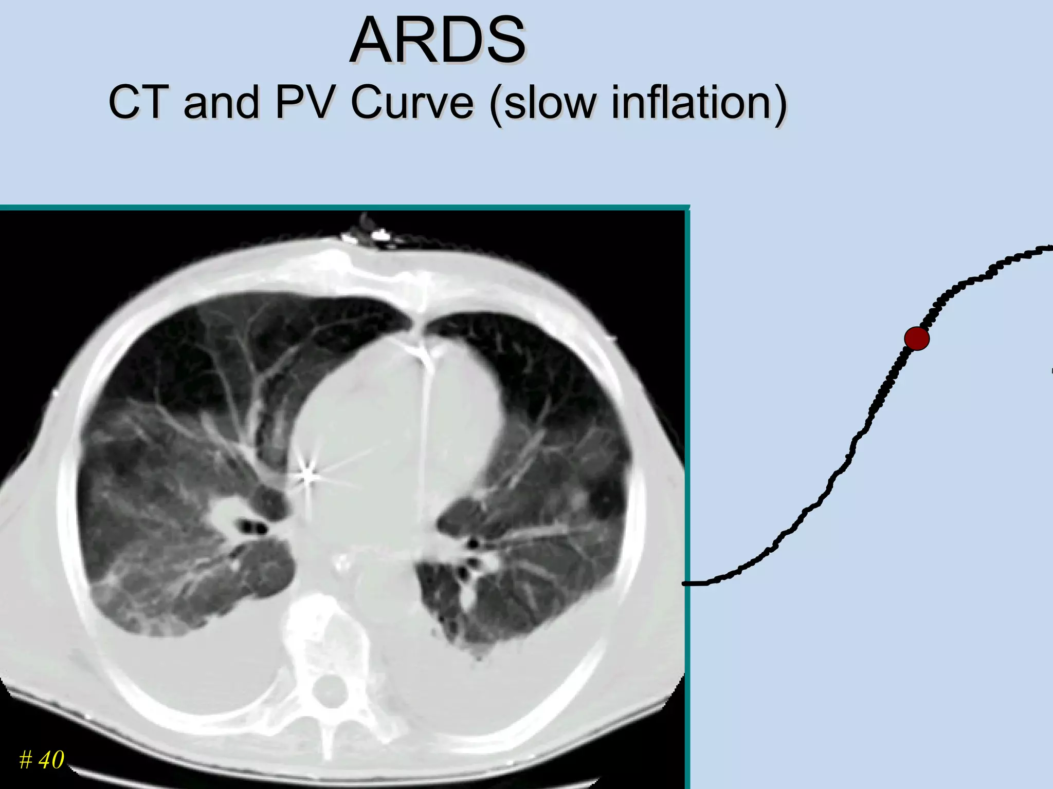 ARDS  CT and PV Curve (slow inflation) # 40 
