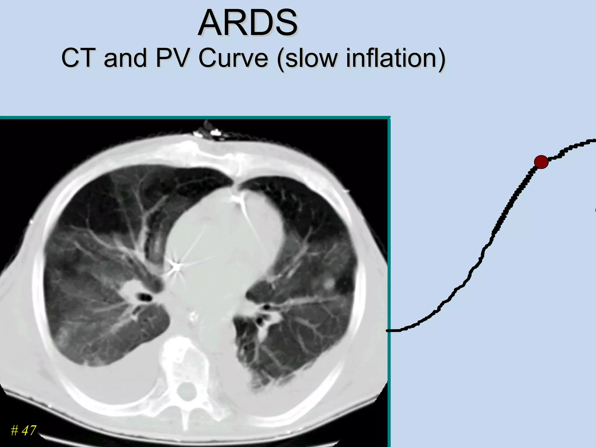 ARDS  CT and PV Curve (slow inflation) # 47 