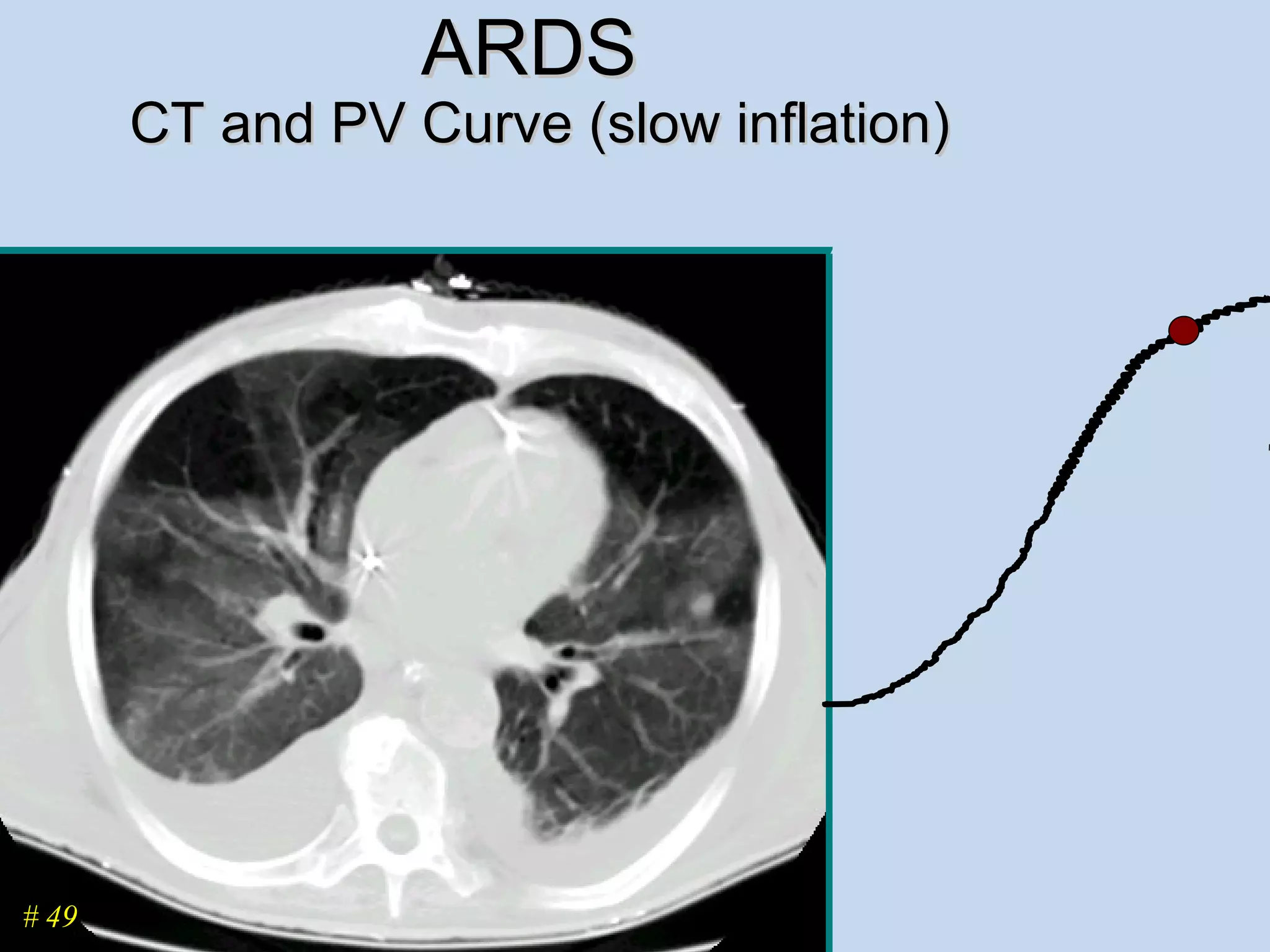 ARDS  CT and PV Curve (slow inflation) # 49 