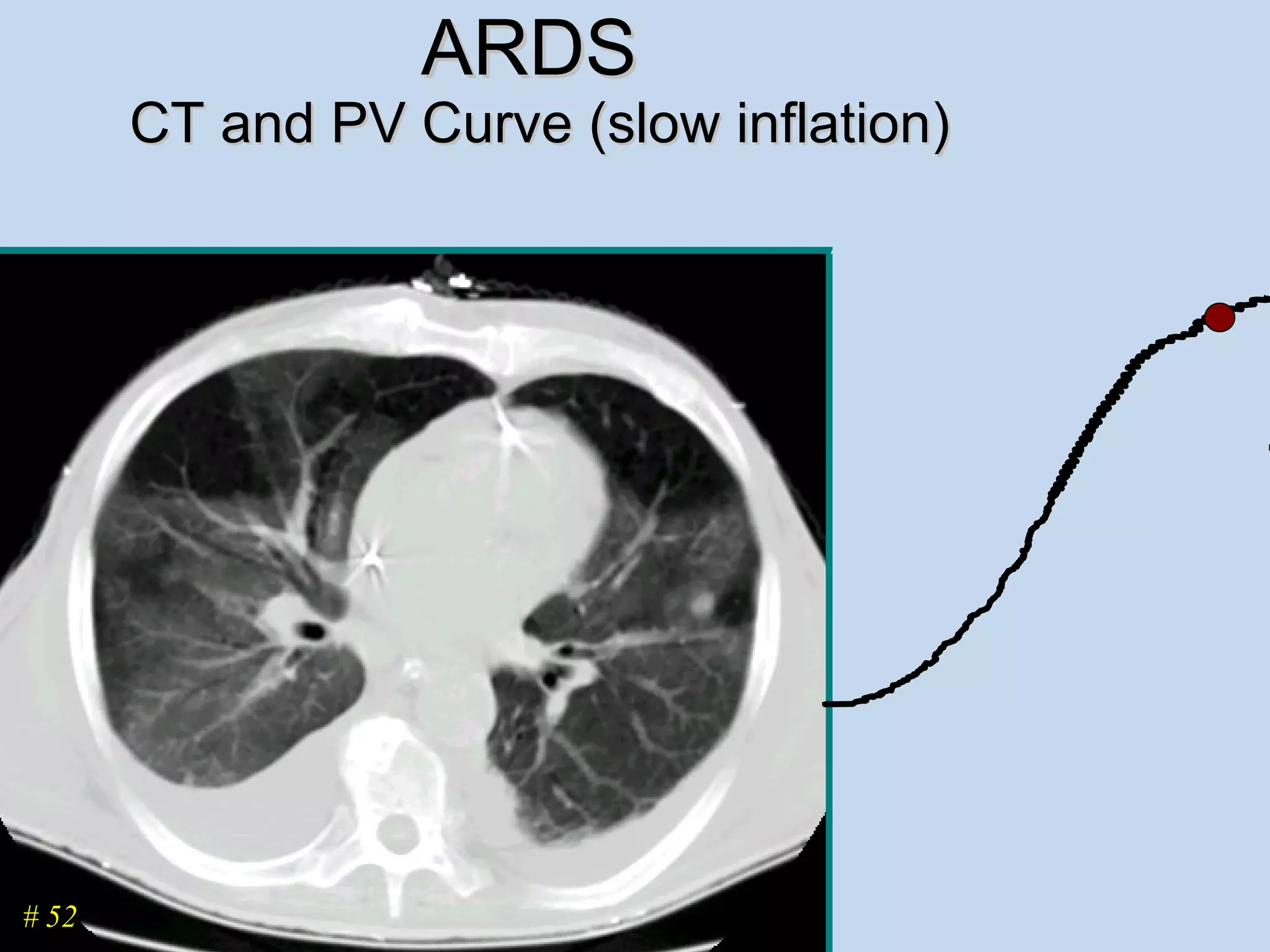 ARDS  CT and PV Curve (slow inflation) # 52 
