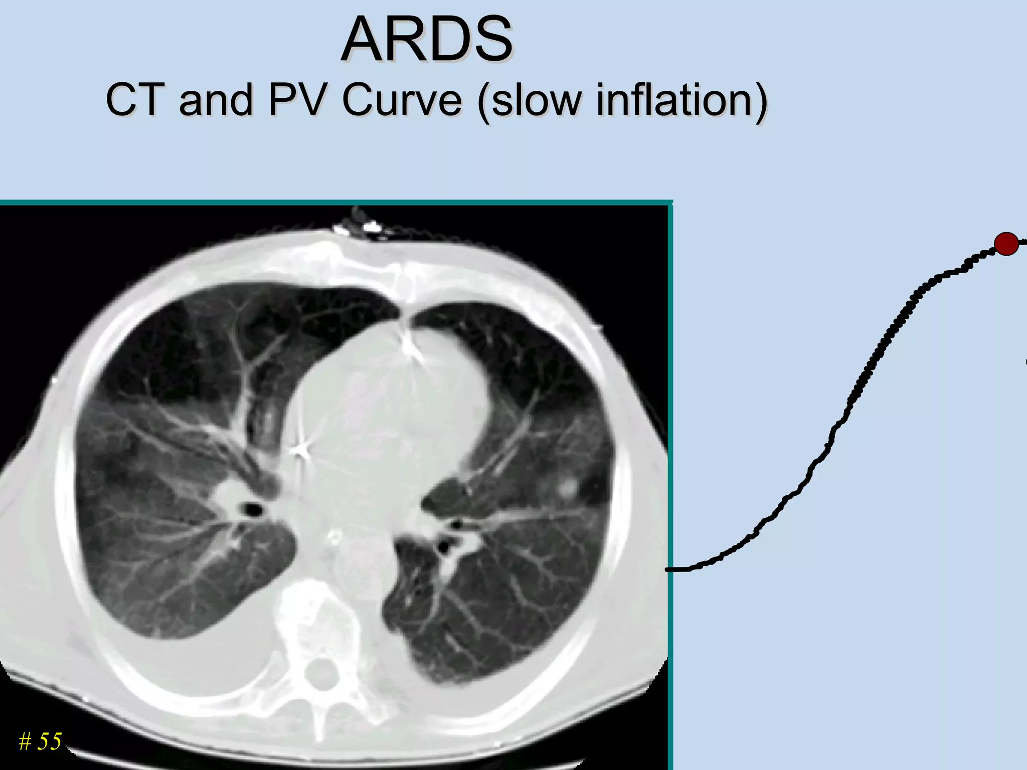 ARDS  CT and PV Curve (slow inflation) # 55 