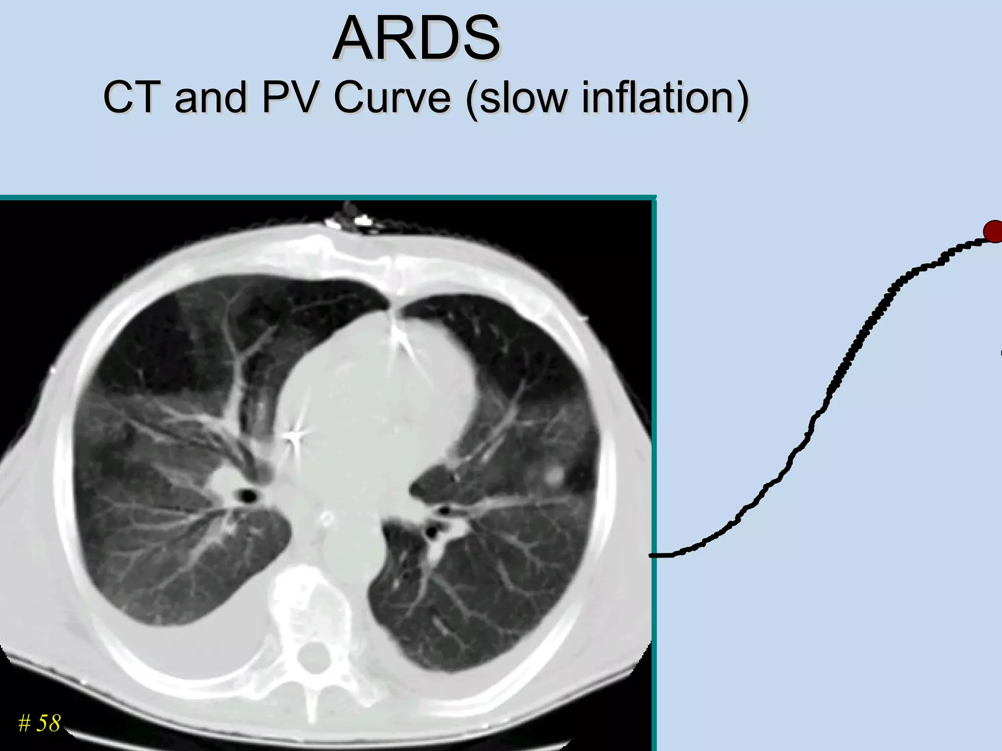 ARDS  CT and PV Curve (slow inflation) # 58 
