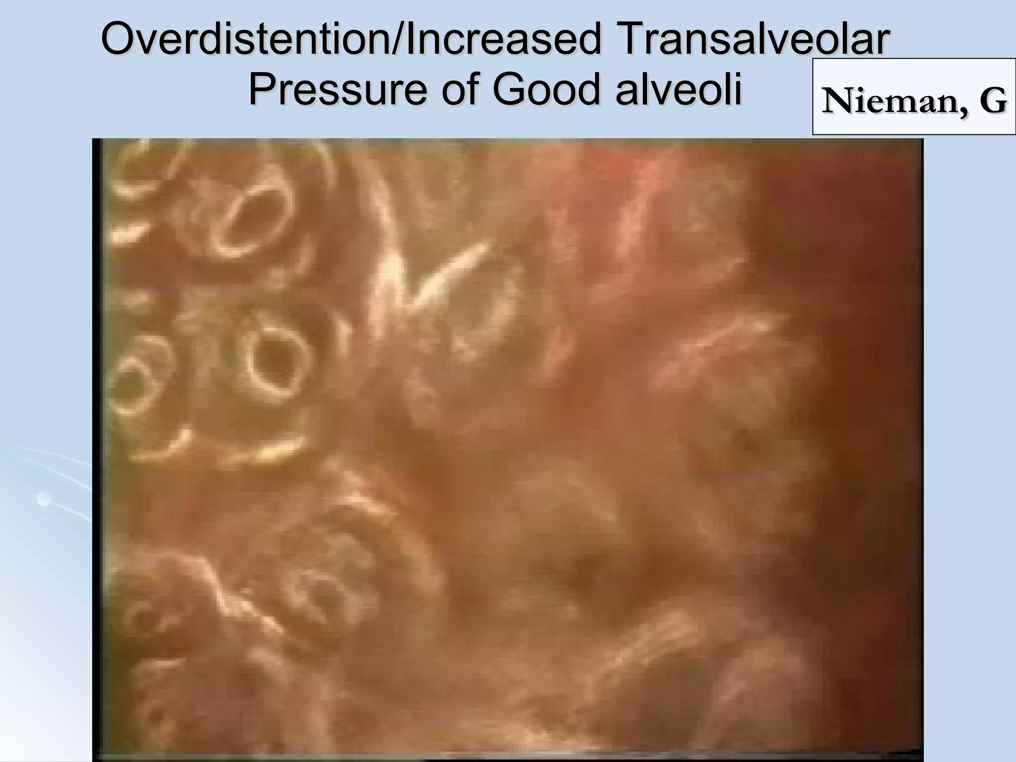 Overdistention/Increased Transalveolar Pressure of Good alveoli Nieman, G 