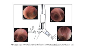 Fibre-optic view of tracheal and bronchial carina with left sided double lumen tube in situ
 