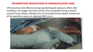 INTERMITTENT REINFLATION OF NONVENTILATED LUNG
HPV becomes more effective during repeated hypoxic exposure. Often after
reinflation, the oxygen saturation will be more acceptable during a second
period of lung collapse. Reexpansion can be performed by regular reexpansion
of the operative lung via an attached CPAP circuit.
 