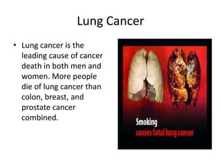 Lung CancerLung cancer is the leading cause of cancer death in both men and women. More people die of lung cancer than colon, breast, and prostate cancer combined.
