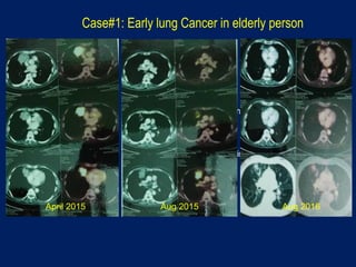 80 yr/ Male
C/o Cough x 3 months
Smoker >20 yrs
PET-CT scan: Mass in Rt lung
Biopsy: Adenocarcinoma
IHC: EGFR- Mutated
Treated with CyberKnife radiosurgery
45Gy/3#
Pescribed at 85% isodose
Case#1: Early lung Cancer in elderly person
April 2015 Aug 2015 Aug 2016
 