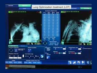 Lung Optimization treatment (LOT)
 