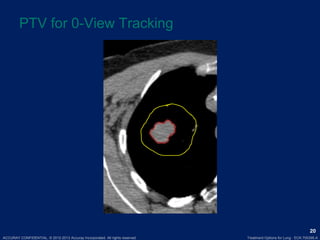ACCURAY CONFIDENTIAL. © 2012-2013 Accuray Incorporated. All rights reserved. Treatment Options for Lung · ECK.700395.A
20
PTV for 0-View Tracking
 