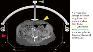 A CT scan slice
through the whole
body frame. Red
arrow, the whole
body frame; yellow
arrow, abdominal
plate; green arrow,
screw to regulate the
degree of abdominal
compression
 