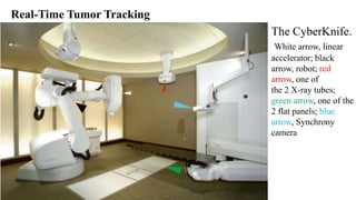 Real-Time Tumor Tracking
The CyberKnife.
White arrow, linear
accelerator; black
arrow, robot; red
arrow, one of
the 2 X-ray tubes;
green arrow, one of the
2 flat panels; blue
arrow, Synchrony
camera
 