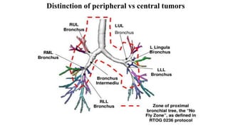 Distinction of peripheral vs central tumors
 
