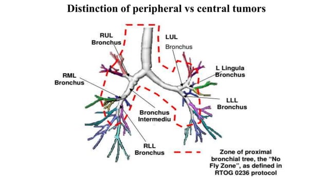 Lung sbrt ppt | PPTX | Lung and Respiratory Health | Diseases and ...