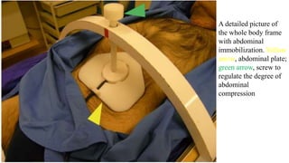 A detailed picture of
the whole body frame
with abdominal
immobilization. Yellow
arrow, abdominal plate;
green arrow, screw to
regulate the degree of
abdominal
compression
 