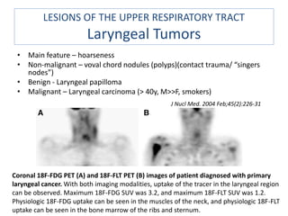 Lung scintigraphy in various lung pathologies | PPTX