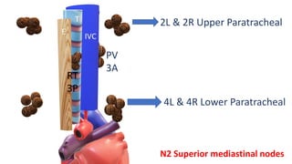 T
E
IVC
PV
3A
RT
3P
2L & 2R Upper Paratracheal
4L & 4R Lower Paratracheal
N2 Superior mediastinal nodes
 