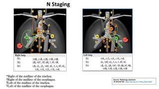 Source: Radiology assistant
El-Sherief AH. https://doi.org/10.1148/rg.346130097
N Staging
 