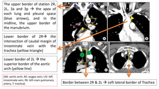 The upper border of station 2R,
2L, 3a and 3p → the apex of
each lung and pleural space
(blue arrows), and in the
midline, the upper border of
the manubrium.
Lower border of 2R→ the
intersection of caudal margin of
innominate vein with the
trachea (yellow triangle)
Lower border of 2L → the
superior border of the aortic
arch (yellow line)
Border between 2R & 2L → Left lateral border of Trachea
(AA: aortic arch; AZ: azygos vein; LIV: left
innominate vein; PA: left main pulmonary
artery; T: trachea)
 