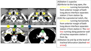 (A)Station 1 supaclav
(B)Inferior to the lung apex, the
yellow line running horizontally
from anterior margin of both
lung pleura interface separates
station 1 from station 3p.
(C)At the suprasternal notch, the
yellow line running horizontally
from anterior margin of both
lung pleura interface separates
station 1 from station 2. The red
line running along posterior wall
of trachea separates station 2
from 3p.
(D)Station 3a and 3p at the level of
tracheal bifurcation (dashed red
arrow).
 