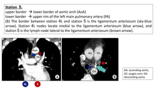Station 5.
upper border → lower border of aortic arch (AoA)
lower border → upper rim of the left main pulmonary artery (PA)
(B) The border between station 4L and station 5 is the ligamentum arteriosum (sky-blue
arrow). Station 4L nodes locate medial to the ligamentum arteriosum (blue arrow), and
station 5 is the lymph node lateral to the ligamentum arteriosum (brown arrow).
AA: ascending aorta;
AZ: azygos vein; DA:
descending aorta.
 