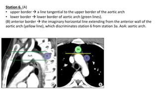 Station 6. (A)
• upper border → a line tangential to the upper border of the aortic arch
• lower border → lower border of aortic arch (green lines).
(B) anterior border → the imaginary horizontal line extending from the anterior wall of the
aortic arch (yellow line), which discriminates station 6 from station 3a. AoA: aortic arch.
 