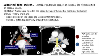 Subcarinal zone: Station 7. (A) Upper and lower borders of station 7 are well identified
on coronal image.
(B) Station 7 nodes are noted in the space between the medial margin of both main
bronchi (yellow lines) and
• nodes outside of the space are station 10 (Hilar nodes).
• Station 7 extends posteriorly around the esophagus.
AoA: aortic arch; BI:
bronchus
intermedius; LLL:
left lower lobe;
LMB: left main
bronchus; RMB:
right main
bronchus; RUL:
right upper lobe.
 