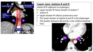 Lower zone: stations 8 and 9:
station 8→ adjacent to esophagus
➢ upper border→ lower border of station 7
• station 9
➢ Upper border→ inferior pulmonary vein.
• The lower border of station 8 and 9 is the diaphragm.
• The border between 8R and 8L is the midline (dashed
line)
 