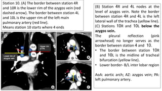 (B) Station 4R and 4L nodes at the
level of azygos vein. Note the border
between station 4R and 4L is the left
lateral wall of the trachea (yellow line).
(C) Stations 10R and 10L below the
azygos vein.
The pleural reflection (pink
arrowhead) no longer serves as the
border between station 4 and 10.
• The border between station 10R
and 10L is the midline of tracheal
bifurcation (yellow line).
• Lower border- B/L inter lobar region
AoA: aortic arch; AZ: azygos vein; PA:
left pulmonary artery.
Station 10. (A) The border between station 4R
and 10R is the lower rim of the azygos vein (red
dashed arrow). The border between station 4L
and 10L is the upper rim of the left main
pulmonary artery (red line).
Means station 10 starts where 4 ends
 