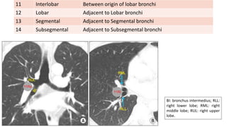 BI: bronchus intermedius; RLL:
right lower lobe; RML: right
middle lobe; RUL: right upper
lobe.
11 Interlobar Between origin of lobar bronchi
12 Lobar Adjacent to Lobar bronchi
13 Segmental Adjacent to Segmental bronchi
14 Subsegmental Adjacent to Subsegmental bronchi
 