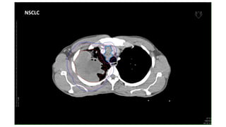 NSCLC
 
