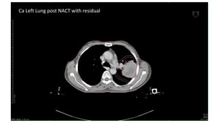 Ca Left Lung post NACT with residual
 