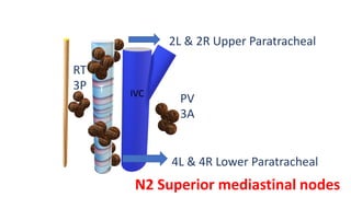 T
E
IVC
PV
3A
RT
3P
2L & 2R Upper Paratracheal
4L & 4R Lower Paratracheal
N2 Superior mediastinal nodes
 