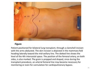 Figure
Patient positioned for bilateral lung transplant, through a clamshell incision
with the arms abducted. The skin incision is depicted in the mammary fold
heading laterally toward the mid-axillary line. The dotted line shows the
level of the 4th intercostal space. The position of the femoral artery, on both
sides, is also marked. The groin is prepped and draped, since during the
transplant procedure, an arterial femoral line may become necessary for
monitoring or even for cannulation for cardiopulmonary bypass.
35
 