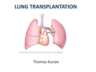LUNG TRANSPLANTATION
Thomas Kurian
1
 