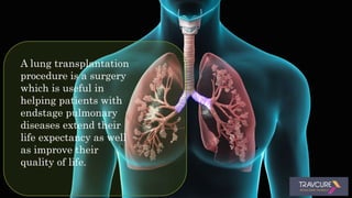 A lung transplantation
procedure is a surgery
which is useful in
helping patients with
endstage pulmonary
diseases extend their
life expectancy as well
as improve their
quality of life.
 