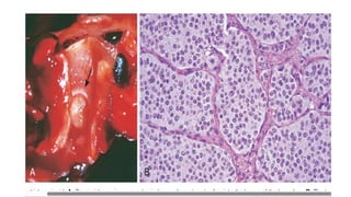Comprehensive Overview of Lung Tumors: Types, Causes, and Clinical ...