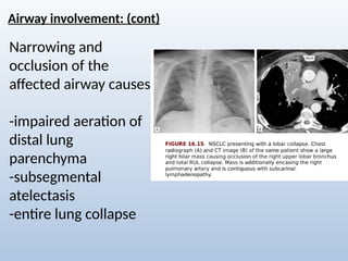 Comprehensive Radiological Overview of Lung Tumors and Thoracic ...