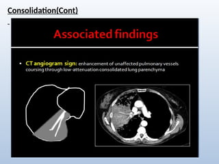 Comprehensive Radiological Overview of Lung Tumors and Thoracic ...