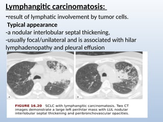 Comprehensive Radiological Overview of Lung Tumors and Thoracic ...