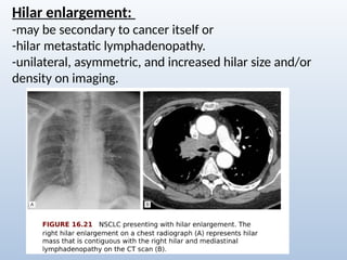 Comprehensive Radiological Overview of Lung Tumors and Thoracic ...