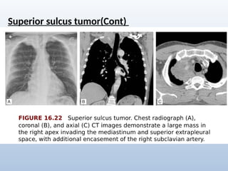 Comprehensive Radiological Overview of Lung Tumors and Thoracic ...